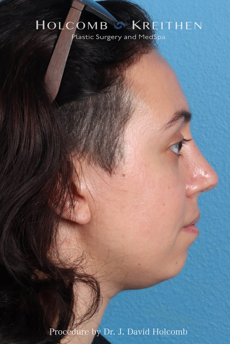 Rhinoplasty Before & After Gallery - Patient 804562 - Image 10