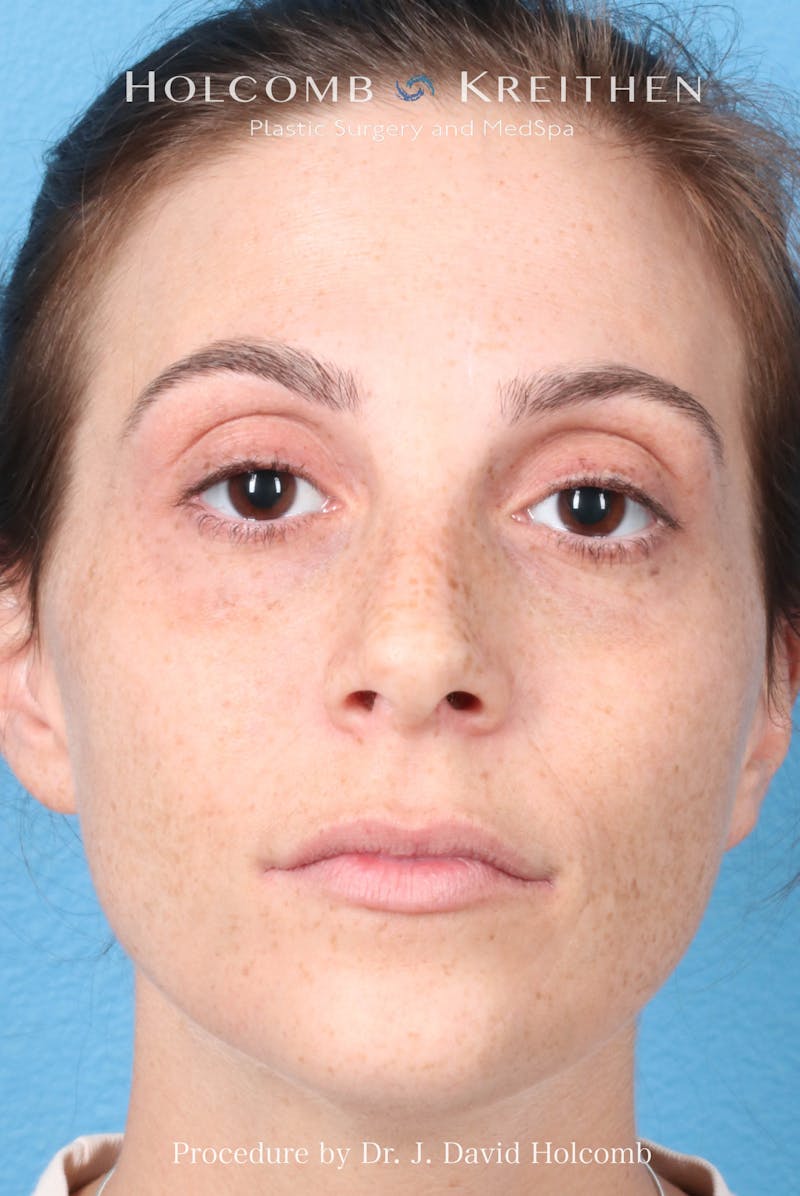 Rhinoplasty Before & After Gallery - Patient 371635 - Image 3