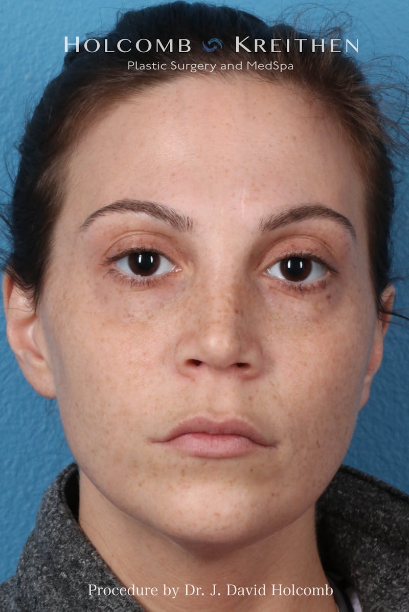 Rhinoplasty Before & After Gallery - Patient 371635 - Image 4