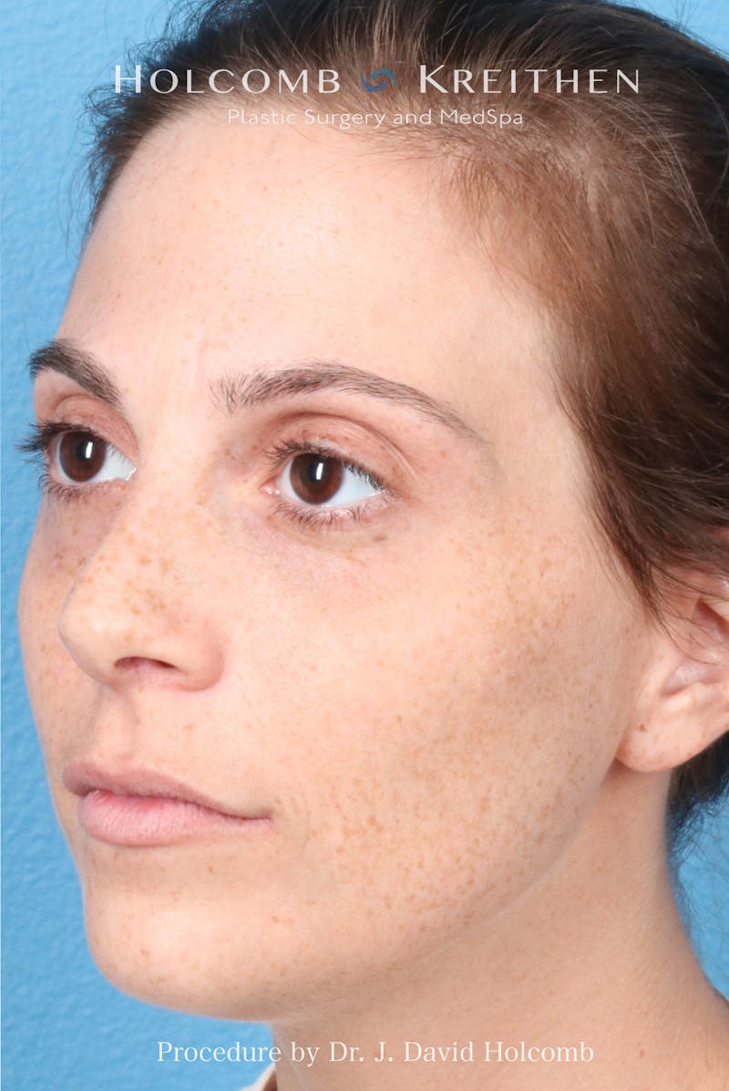 Rhinoplasty Before & After Gallery - Patient 371635 - Image 5