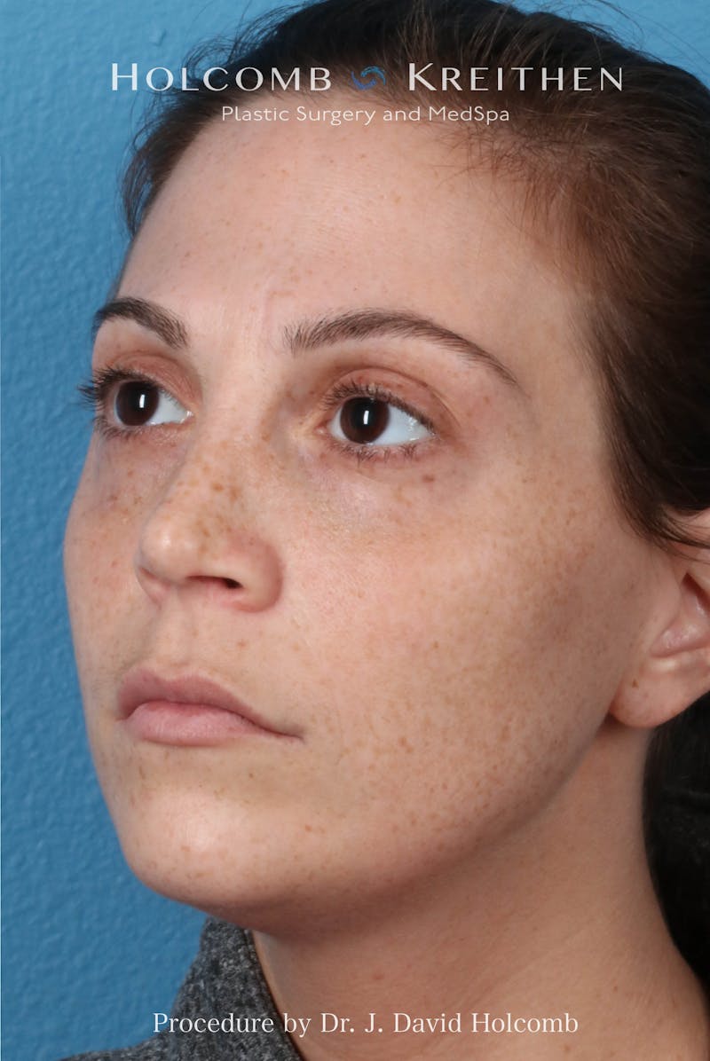Rhinoplasty Before & After Gallery - Patient 371635 - Image 6