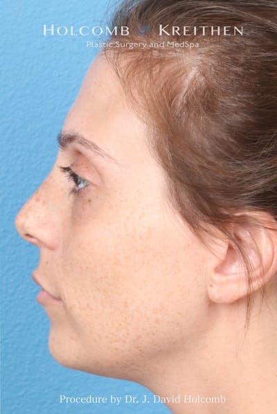 Rhinoplasty Before & After Gallery - Patient 371635 - Image 1