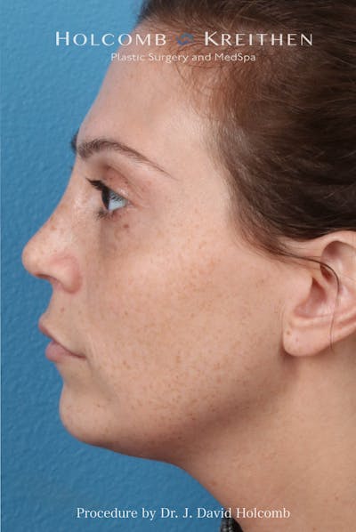 Rhinoplasty Before & After Gallery - Patient 371635 - Image 2