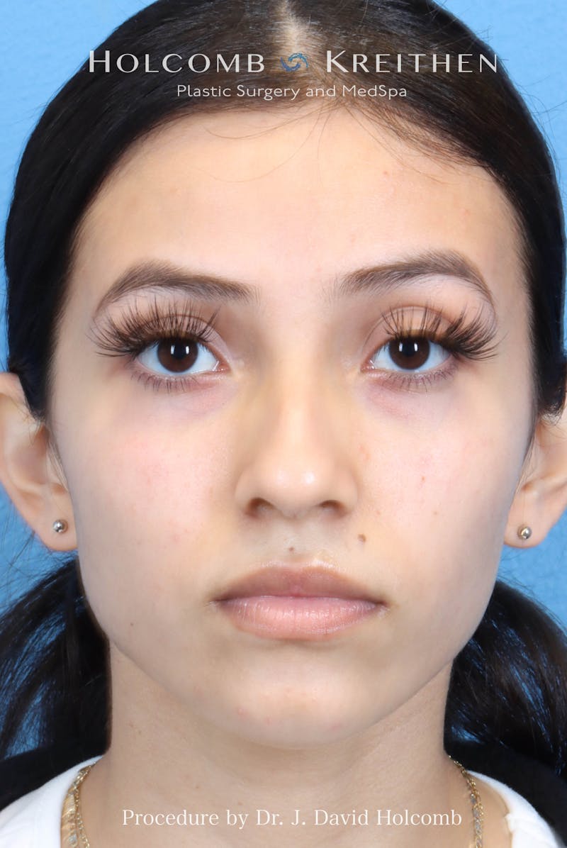 Rhinoplasty Before & After Gallery - Patient 385223 - Image 3
