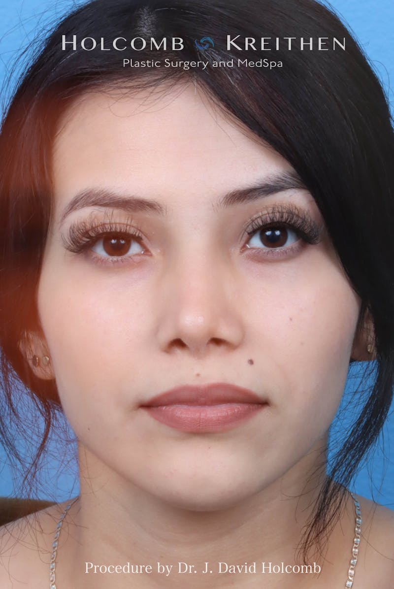 Rhinoplasty Before & After Gallery - Patient 385223 - Image 4