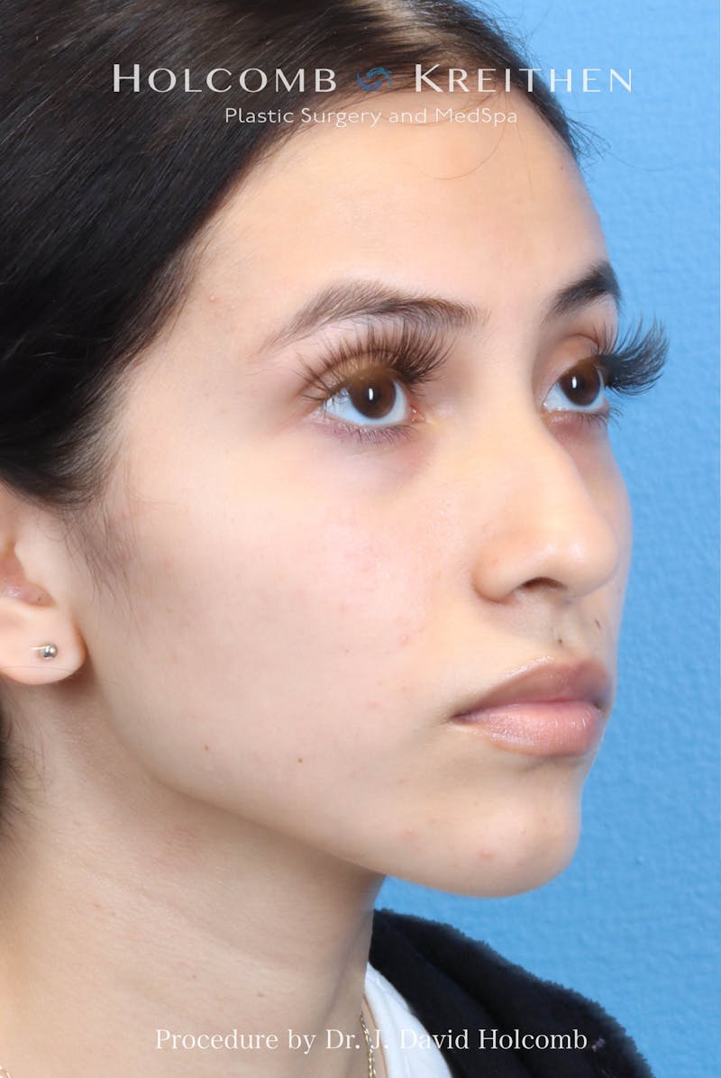 Rhinoplasty Before & After Gallery - Patient 385223 - Image 5