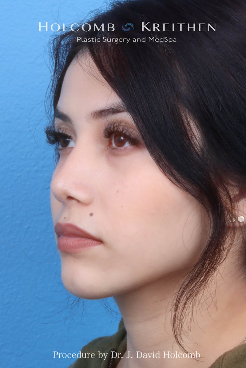 Rhinoplasty Before & After Gallery - Patient 385223 - Image 8