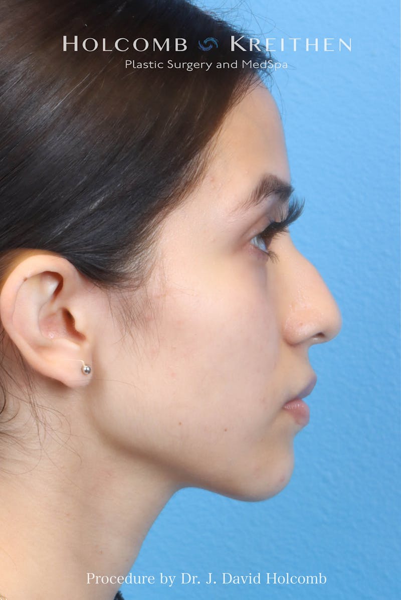 Rhinoplasty Before & After Gallery - Patient 385223 - Image 9