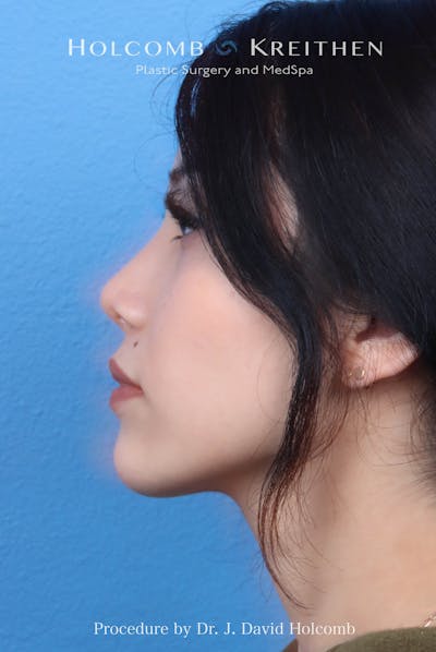 Rhinoplasty Before & After Gallery - Patient 385223 - Image 2