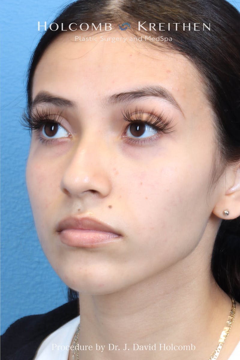 Rhinoplasty Before & After Gallery - Patient 385223 - Image 7