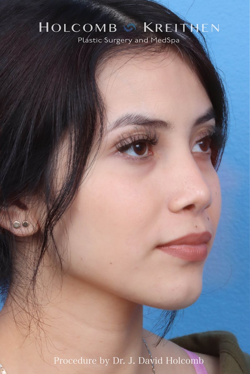 Rhinoplasty Before & After Gallery - Patient 385223 - Image 6
