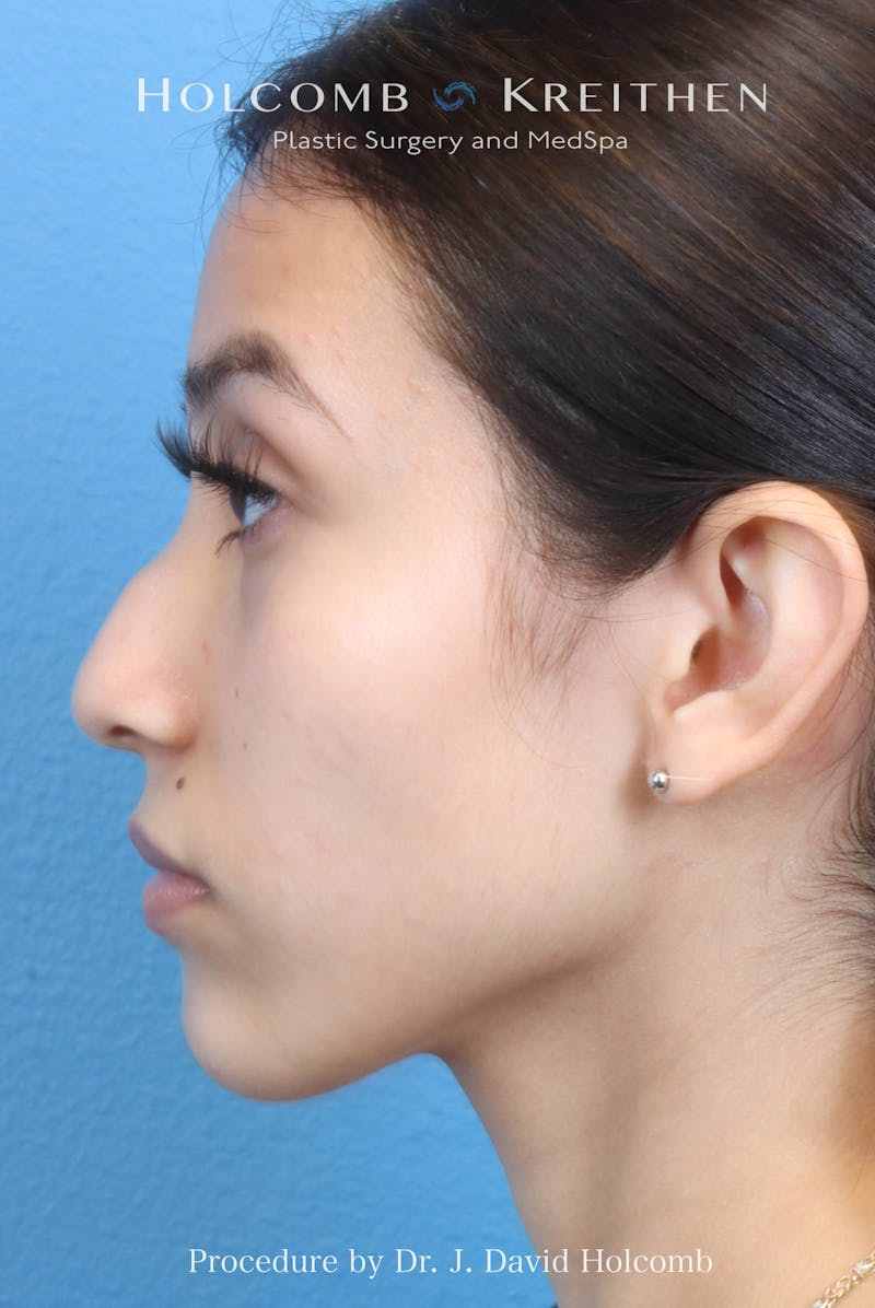 Rhinoplasty Before & After Gallery - Patient 385223 - Image 1