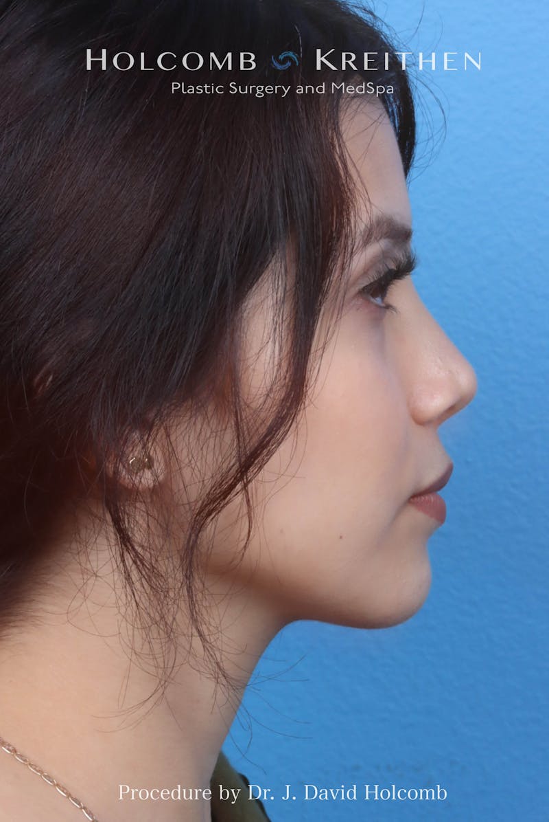 Rhinoplasty Before & After Gallery - Patient 385223 - Image 10