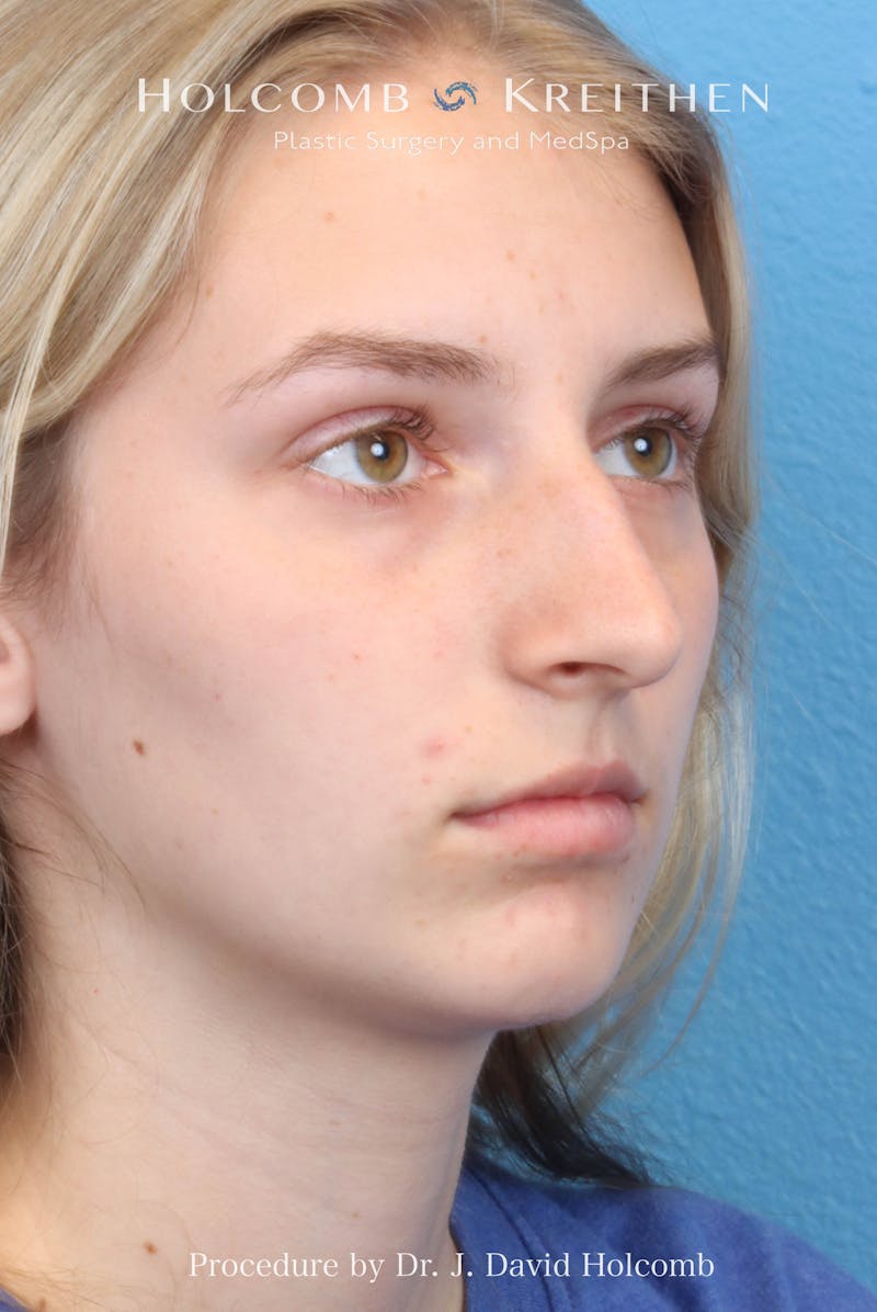 Rhinoplasty Before & After Gallery - Patient 313738 - Image 5