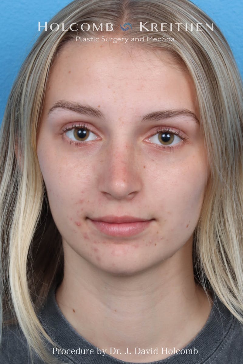 Rhinoplasty Before & After Gallery - Patient 313738 - Image 4
