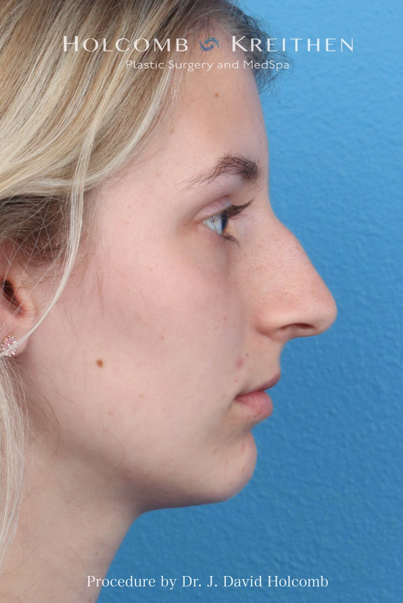 Rhinoplasty Before & After Gallery - Patient 313738 - Image 1