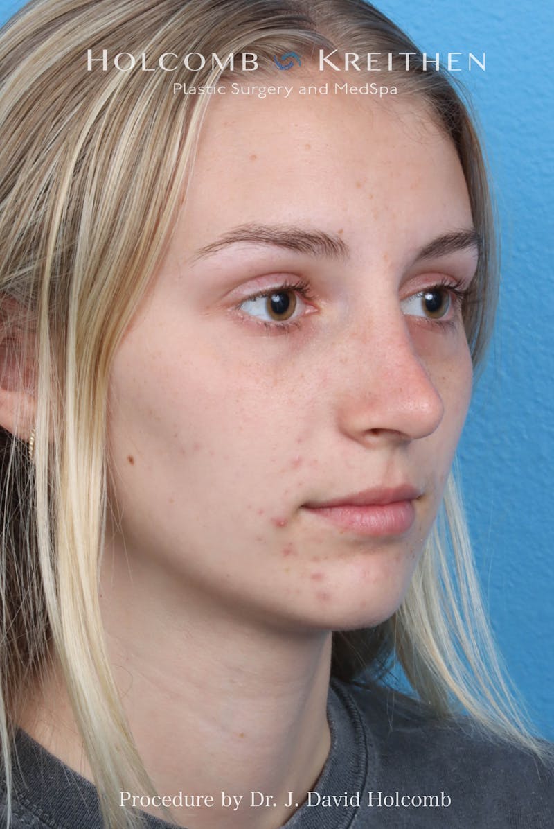 Rhinoplasty Before & After Gallery - Patient 313738 - Image 6