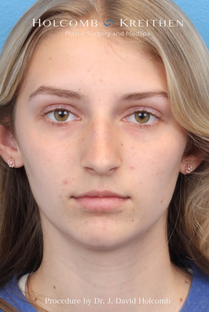 Rhinoplasty Before & After Gallery - Patient 313738 - Image 3