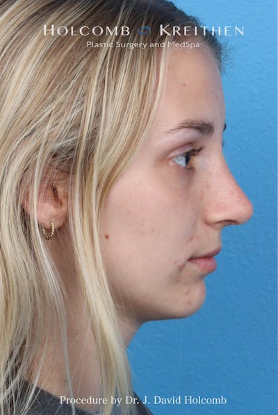 Rhinoplasty Before & After Gallery - Patient 313738 - Image 2