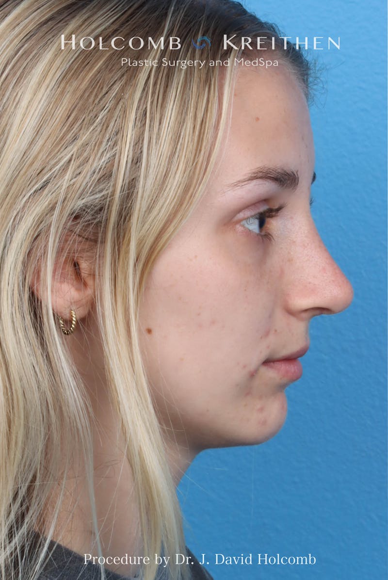 Rhinoplasty Before & After Gallery - Patient 313738 - Image 2