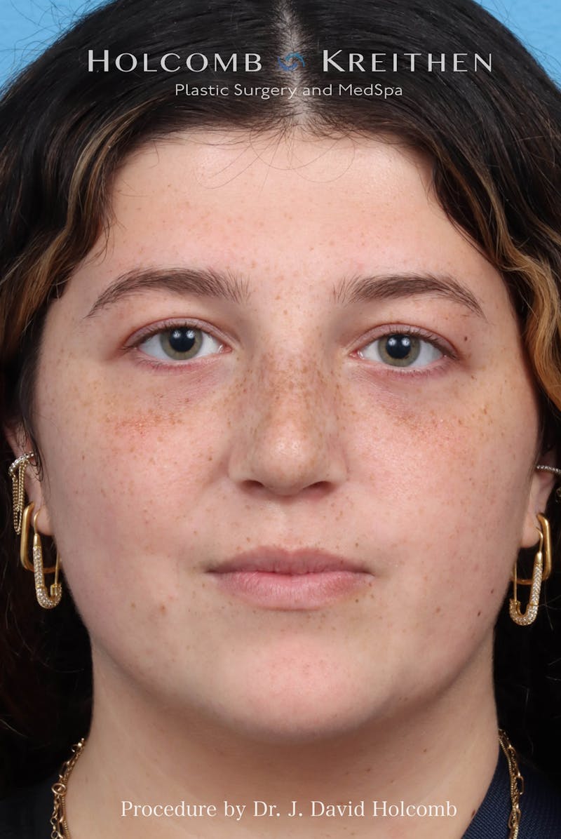 Rhinoplasty Before & After Gallery - Patient 279610 - Image 3