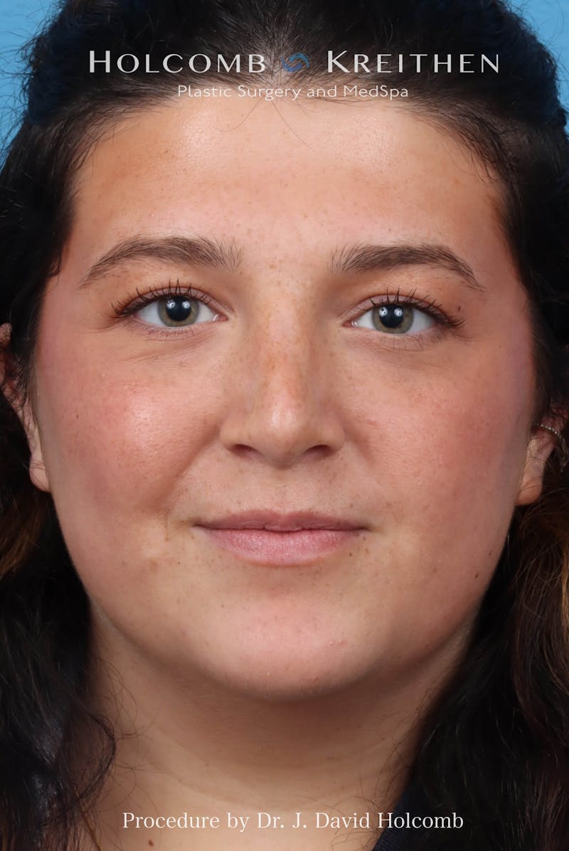 Rhinoplasty Before & After Gallery - Patient 279610 - Image 4