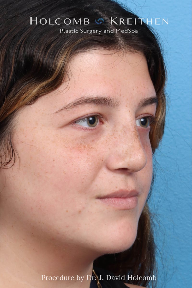 Rhinoplasty Before & After Gallery - Patient 279610 - Image 5