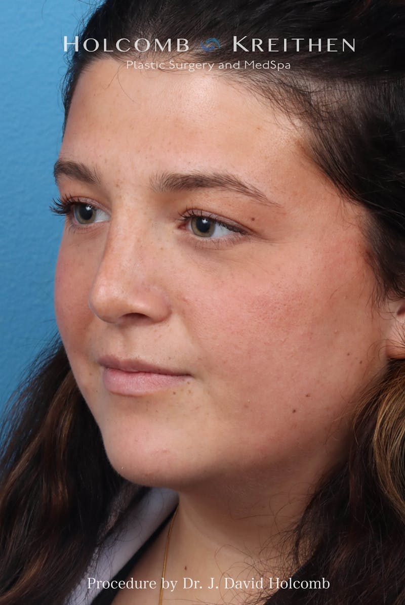 Rhinoplasty Before & After Gallery - Patient 279610 - Image 8