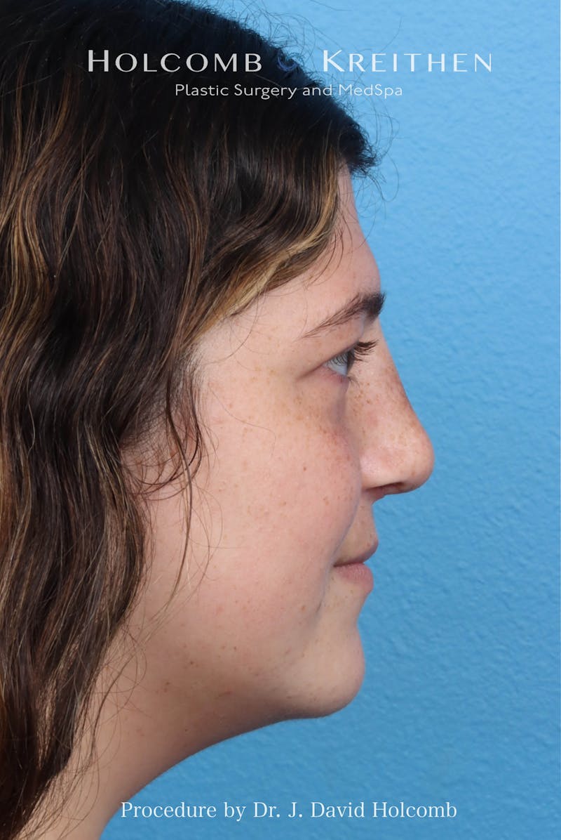 Rhinoplasty Before & After Gallery - Patient 279610 - Image 9