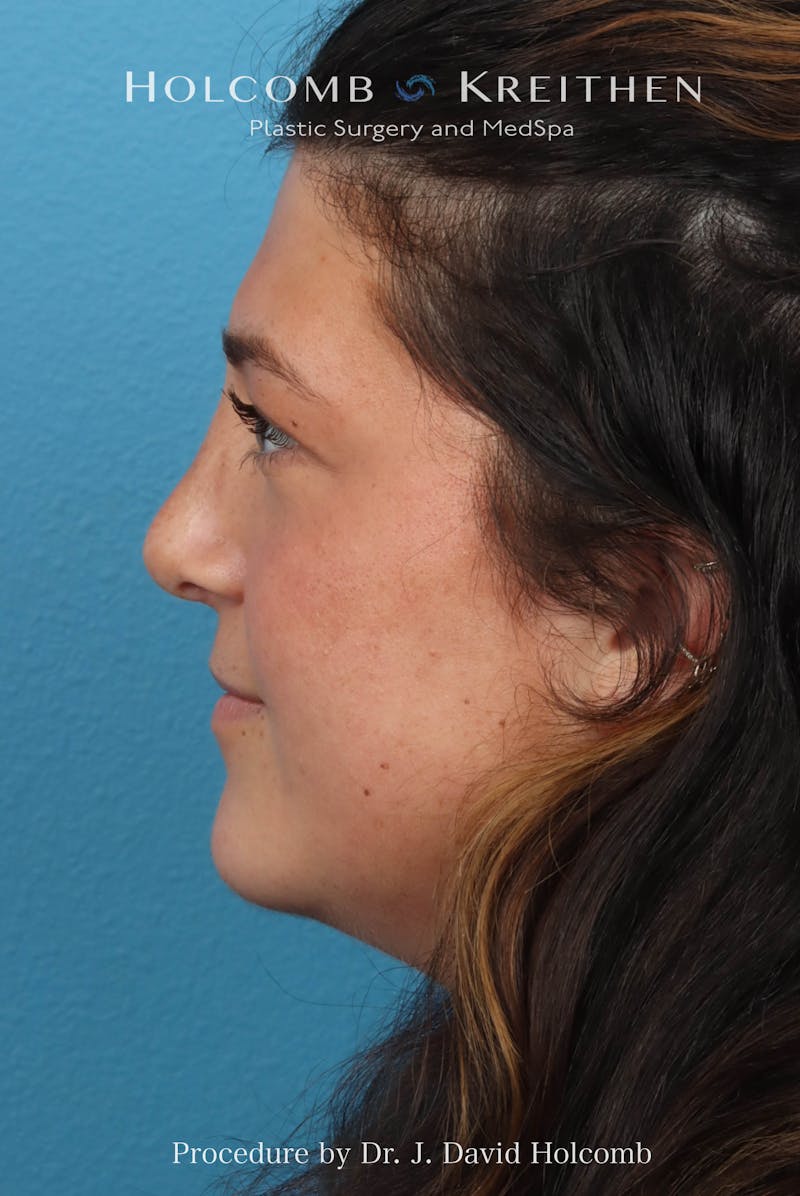 Rhinoplasty Before & After Gallery - Patient 279610 - Image 2