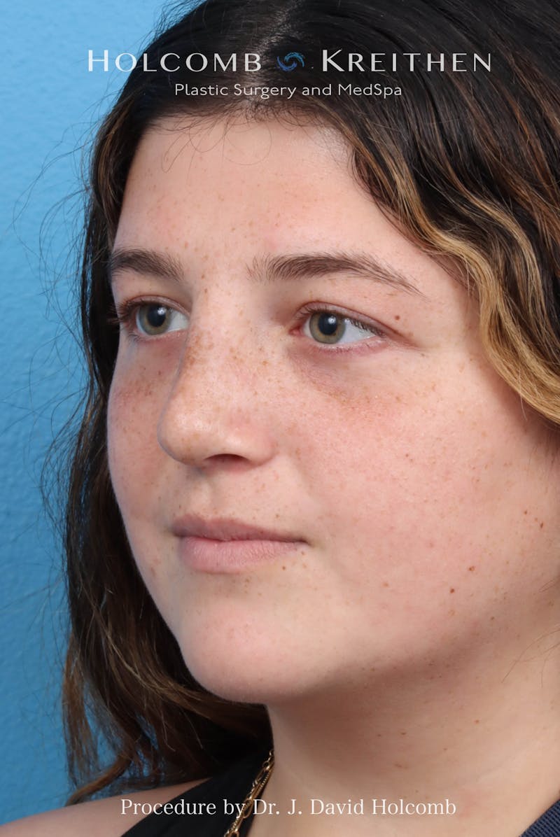 Rhinoplasty Before & After Gallery - Patient 279610 - Image 7