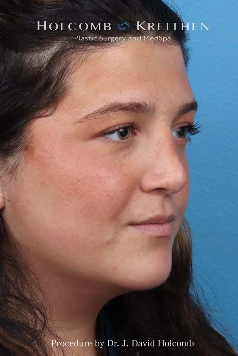 Rhinoplasty Before & After Gallery - Patient 279610 - Image 6