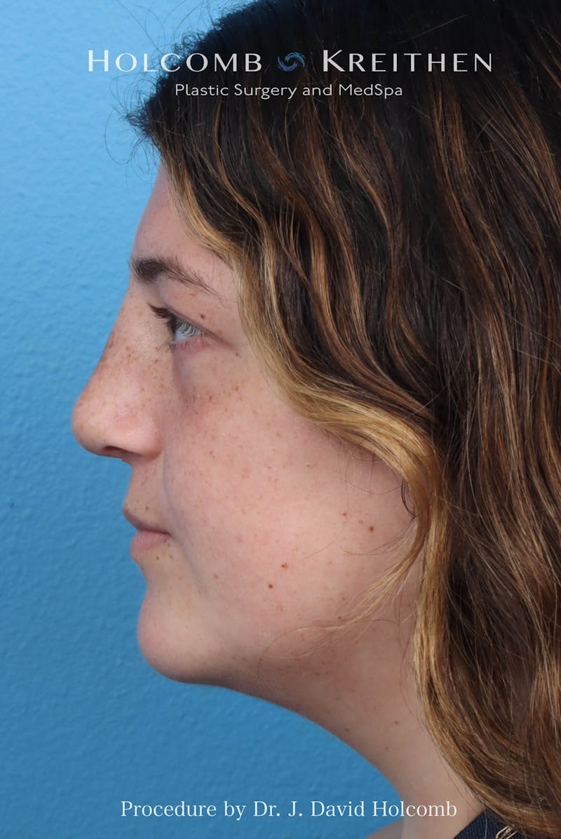 Rhinoplasty Before & After Gallery - Patient 279610 - Image 1
