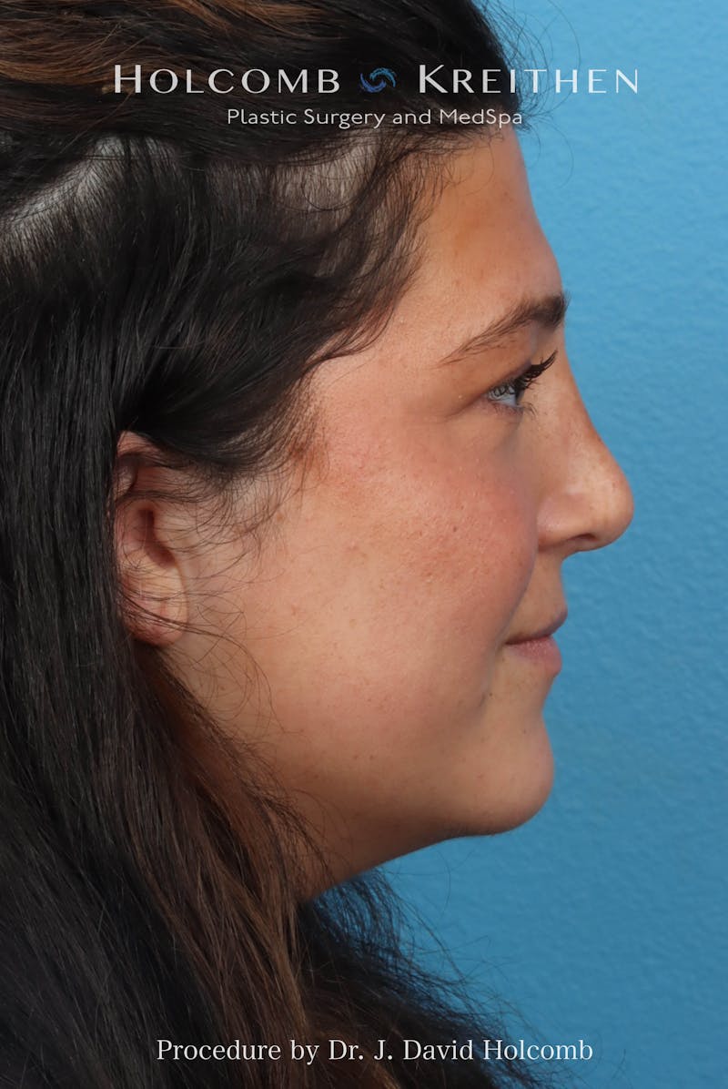 Rhinoplasty Before & After Gallery - Patient 279610 - Image 10