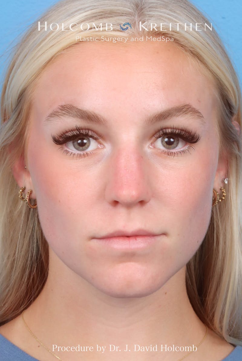 Rhinoplasty Before & After Gallery - Patient 115740 - Image 3