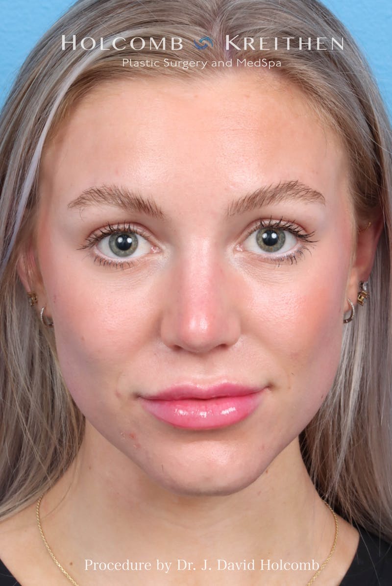Rhinoplasty Before & After Gallery - Patient 115740 - Image 4