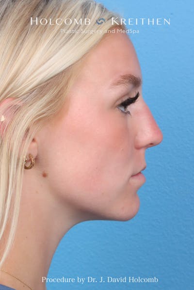Rhinoplasty Before & After Gallery - Patient 115740 - Image 1