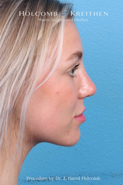 Rhinoplasty Before & After Gallery - Patient 115740 - Image 2