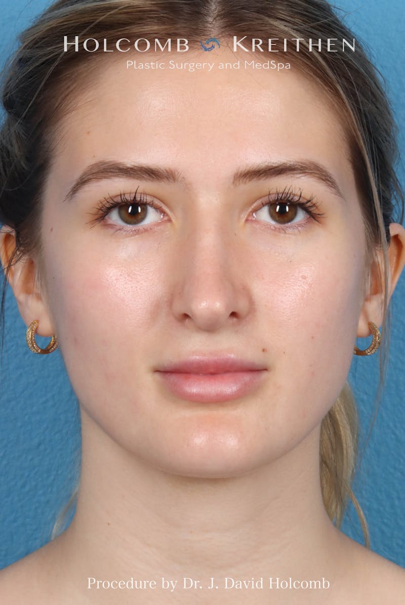 Rhinoplasty Before & After Gallery - Patient 370332 - Image 3