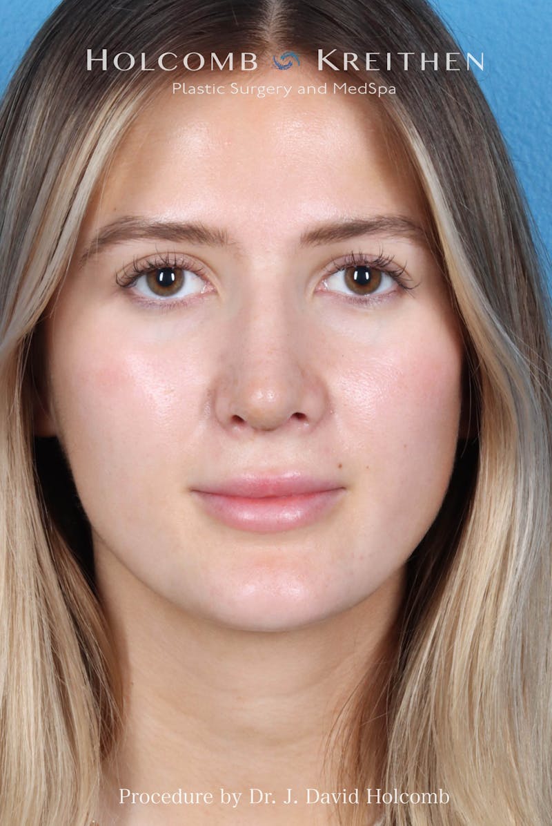 Rhinoplasty Before & After Gallery - Patient 370332 - Image 4