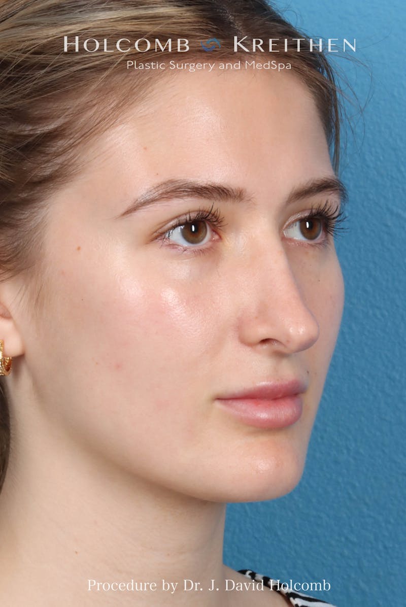 Rhinoplasty Before & After Gallery - Patient 370332 - Image 5
