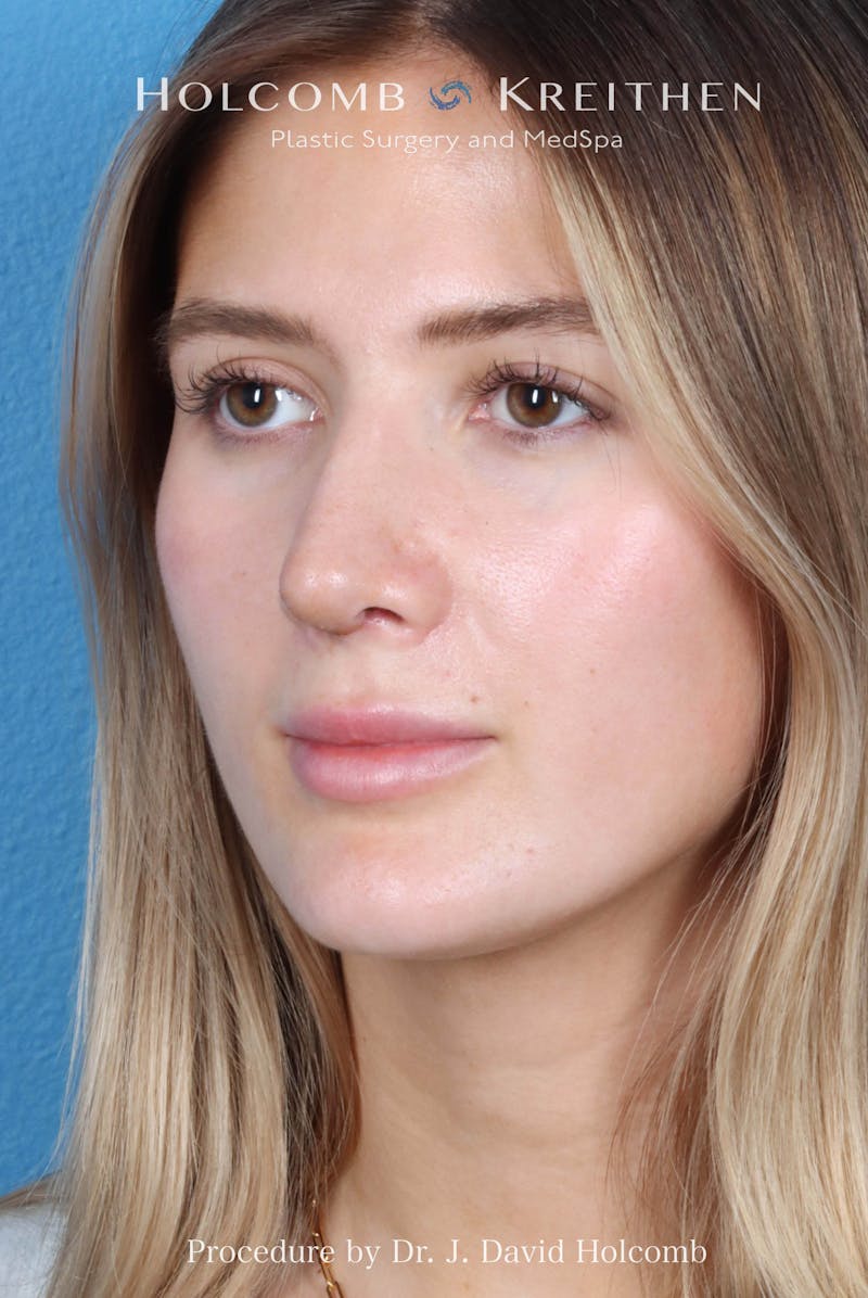 Rhinoplasty Before & After Gallery - Patient 370332 - Image 8