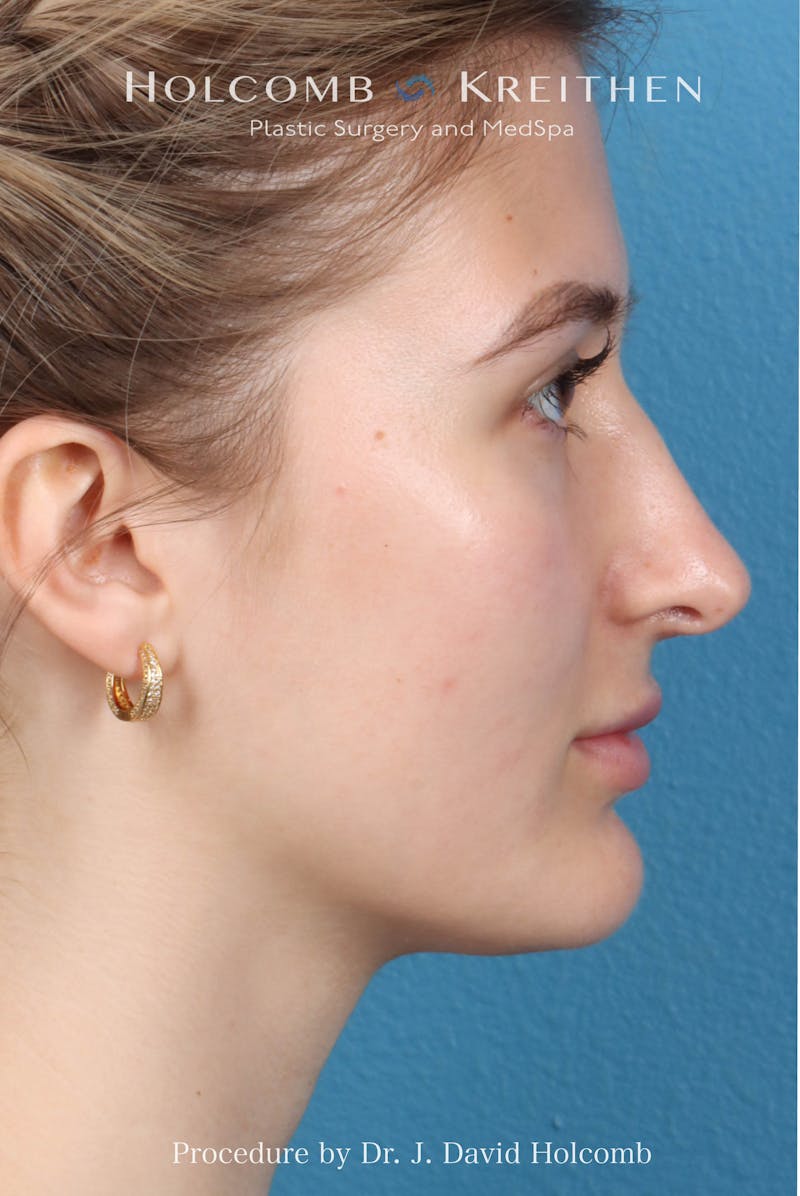 Rhinoplasty Before & After Gallery - Patient 370332 - Image 9
