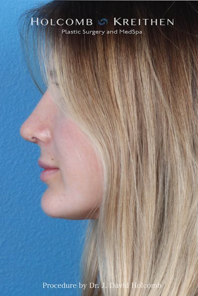 Rhinoplasty Before & After Gallery - Patient 370332 - Image 2