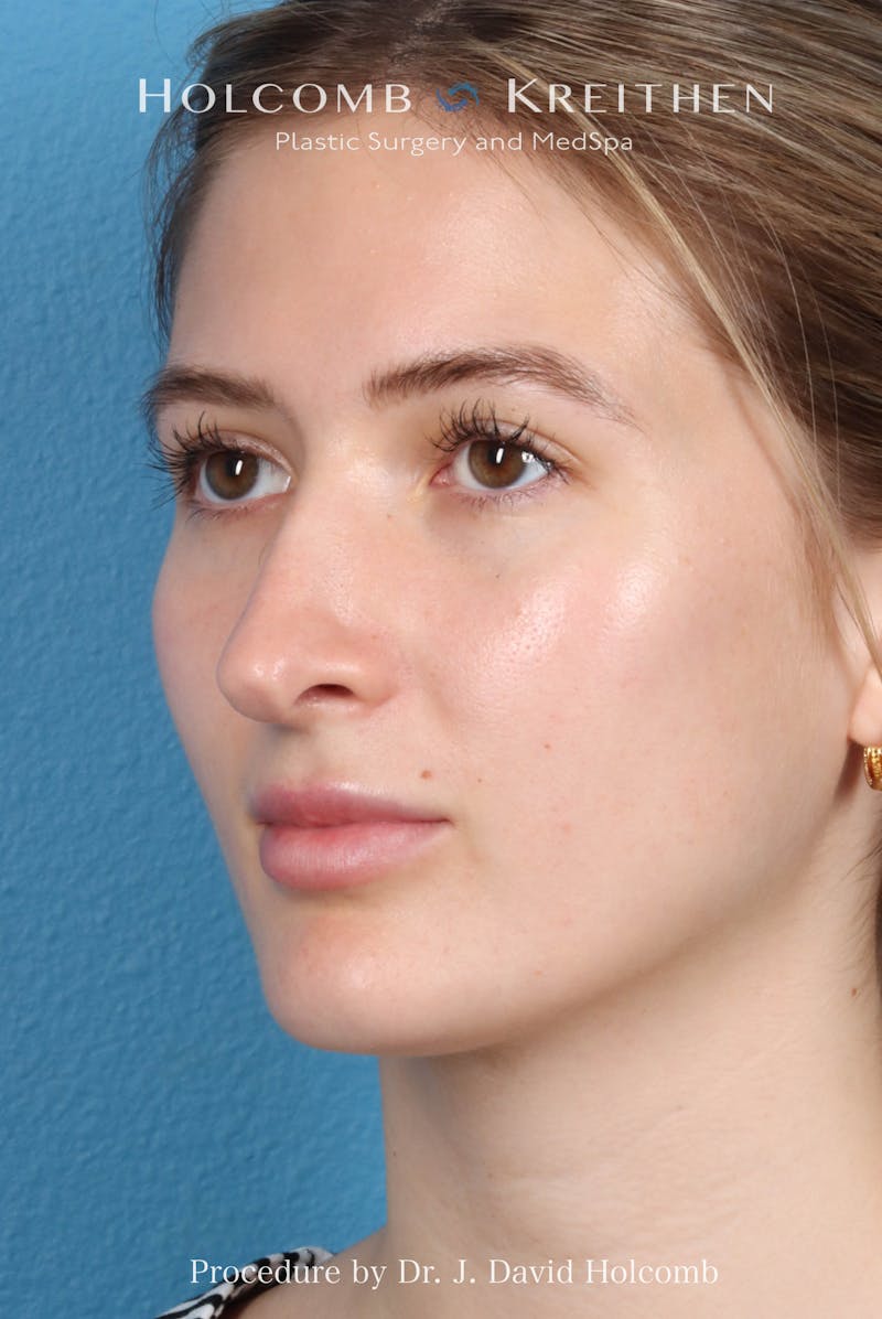 Rhinoplasty Before & After Gallery - Patient 370332 - Image 7