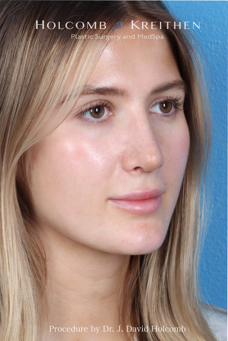 Rhinoplasty Before & After Gallery - Patient 370332 - Image 6