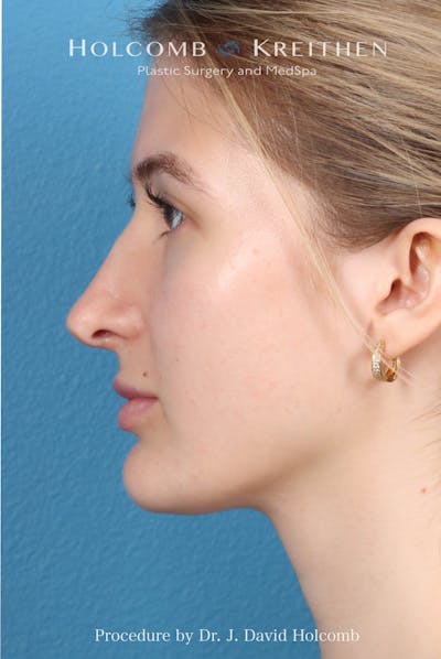 Rhinoplasty Before & After Gallery - Patient 370332 - Image 1