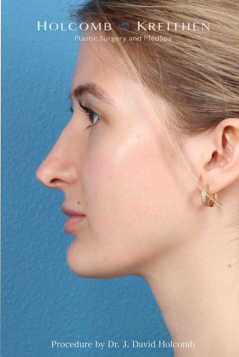 Rhinoplasty Before & After Gallery - Patient 370332 - Image 1