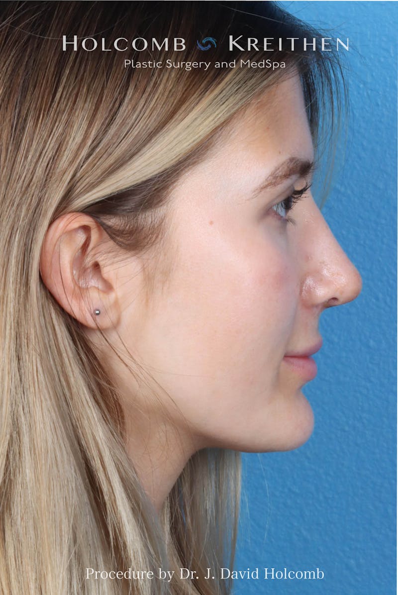 Rhinoplasty Before & After Gallery - Patient 370332 - Image 10