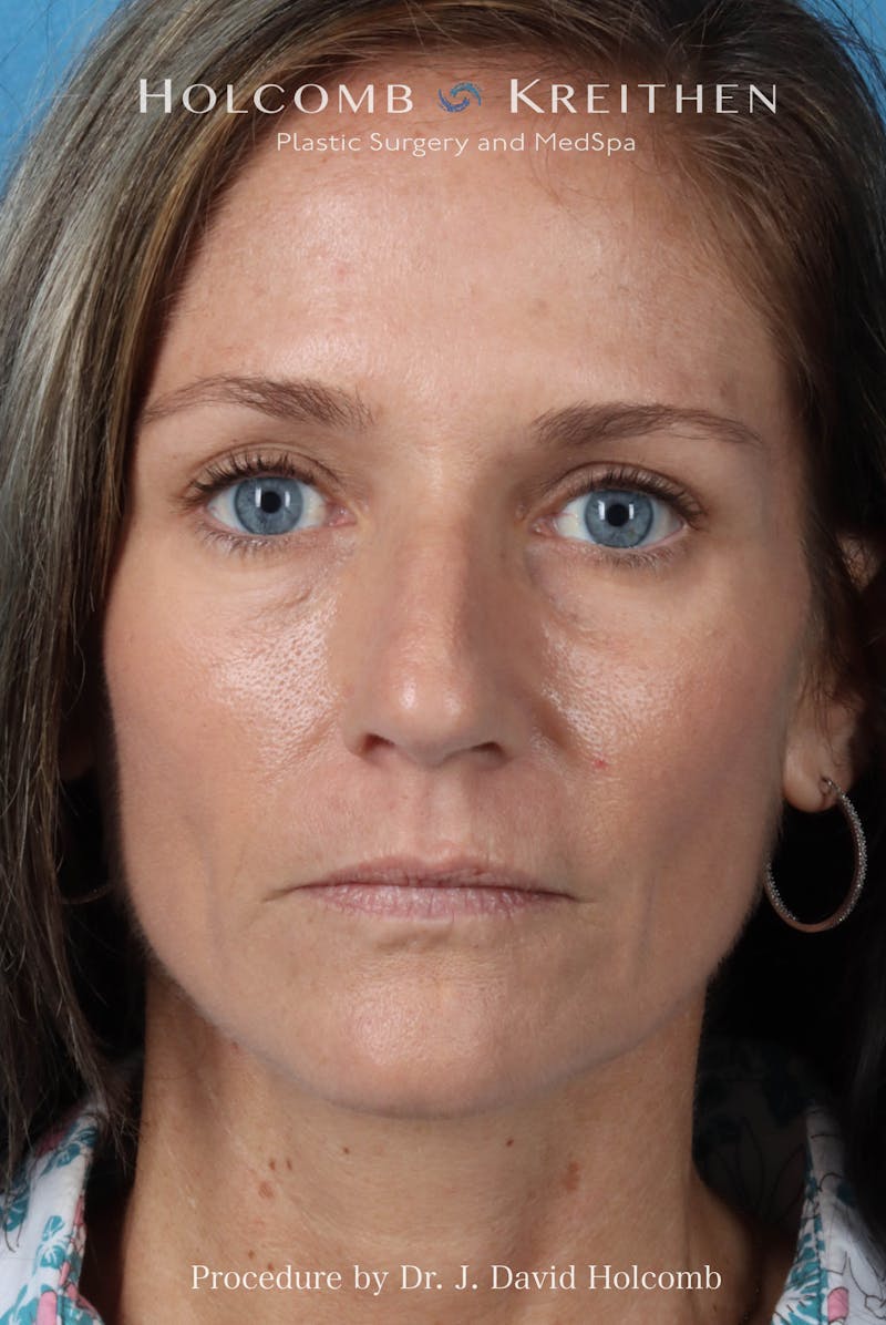 Rhinoplasty Before & After Gallery - Patient 104927 - Image 3